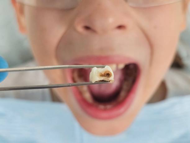 Best Emergency Dentist for Lost Fillings or Crowns in Pine Lake Park, NJ
